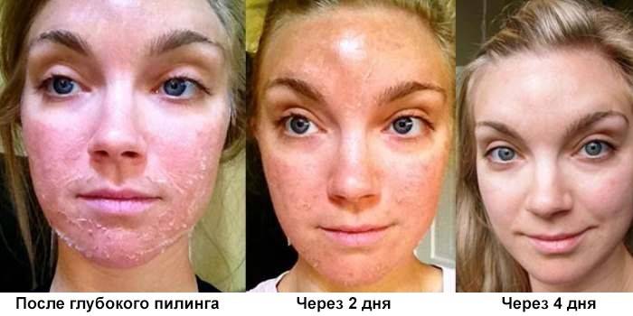 Результат глубокого пилинга