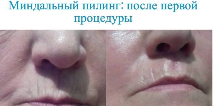 Кожа после процедуры