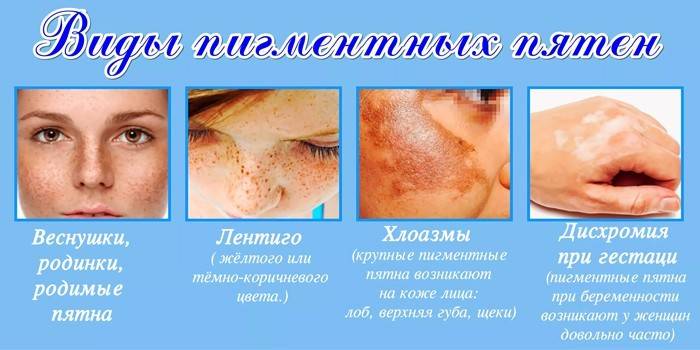 Виды пигментных пятен