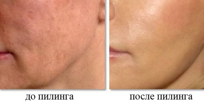 Фото до и после химического пилинга