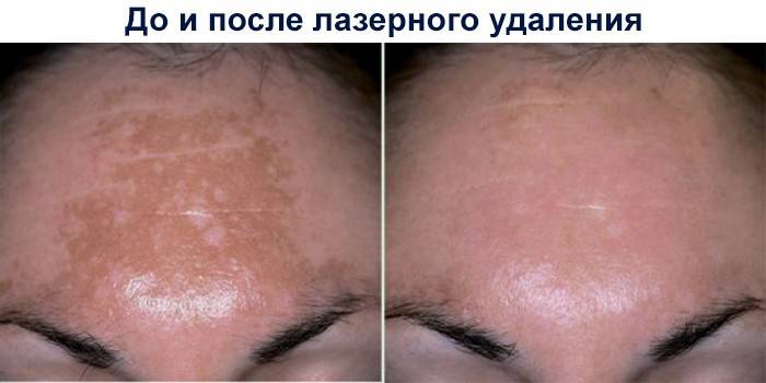 Результаты лазерного удаления