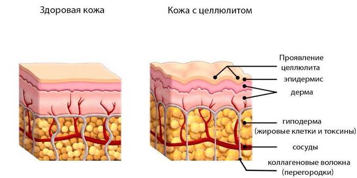 Здоровая кожа и с целлюлитом