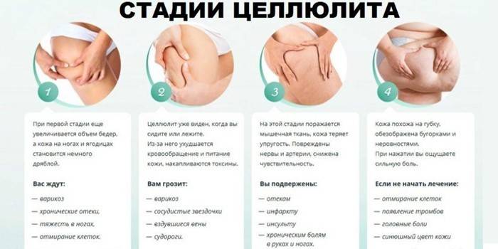 Стадии липодистрофии