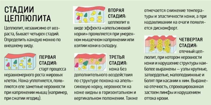 Признаки стадий целлюлита