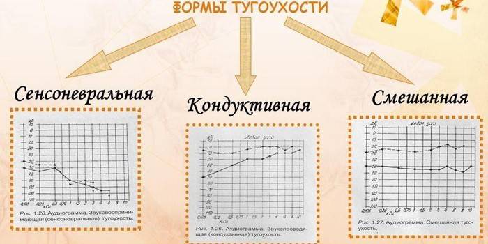 Формы тугоухости