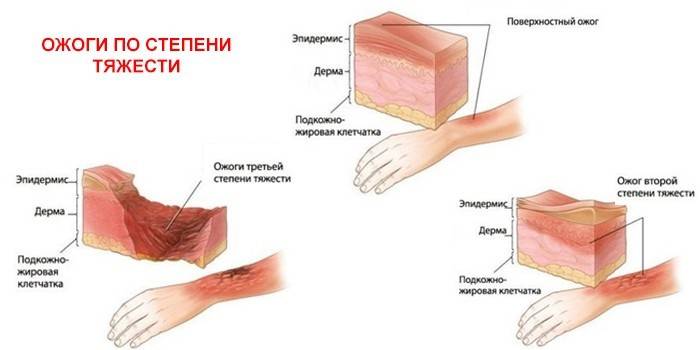 Степени тяжести ожогов