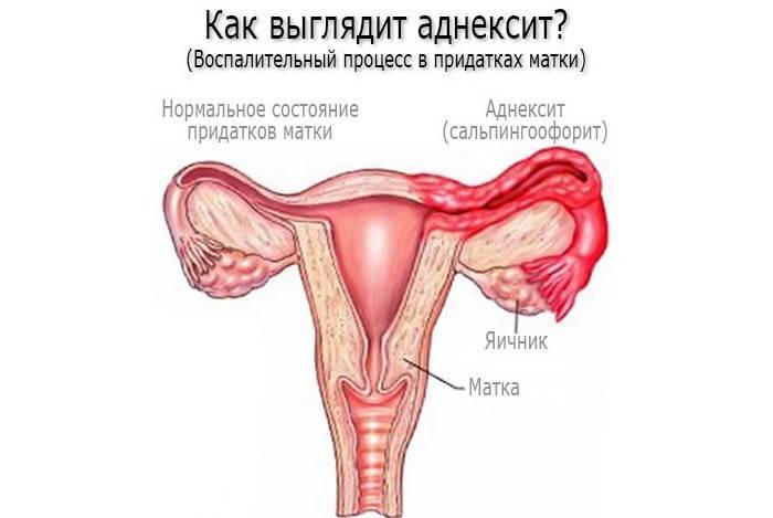 Аднексит на схеме