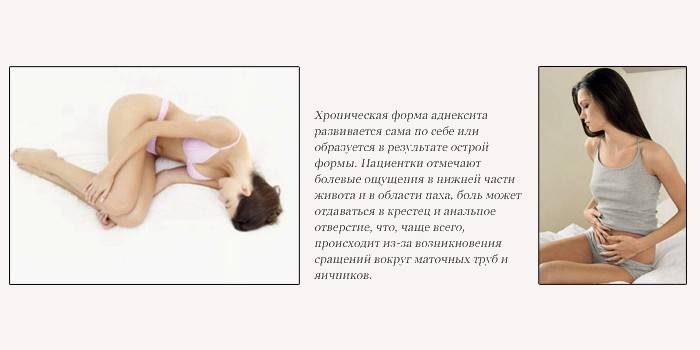 Симптомы при хроническом аднексите