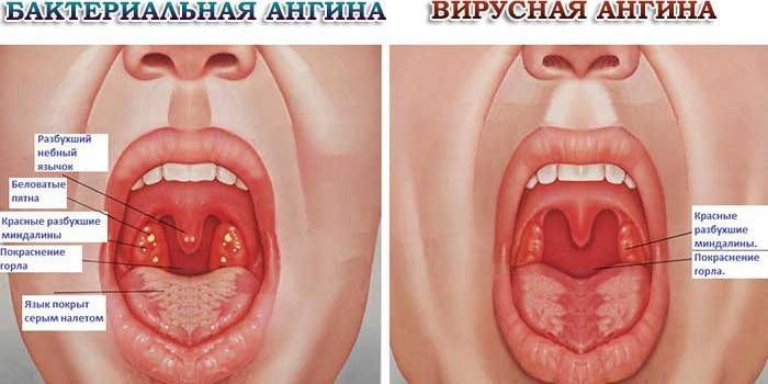 Бактериальная и вирусная ангина