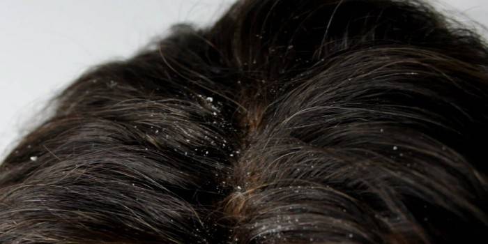 Сухая себорея волосистой части головы