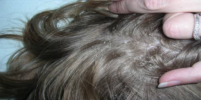 Проявления сухой себореи на коже головы у женщины