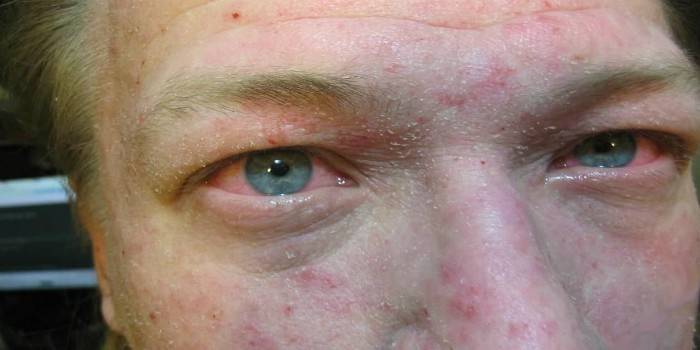 Проявления сухой себореи на лице у мужчины