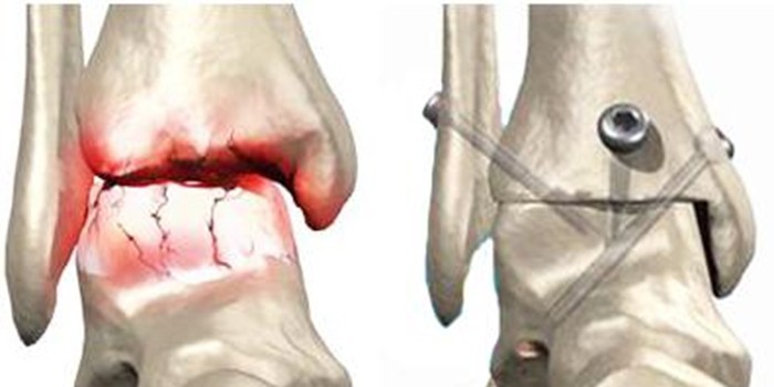 Изображение - Диагноз артроз коленного сустава 2 степени 1129815-artrodez-kolena