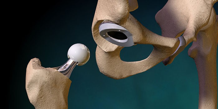 Тотальное эндопротезирование тазобедренного сустава ход операции