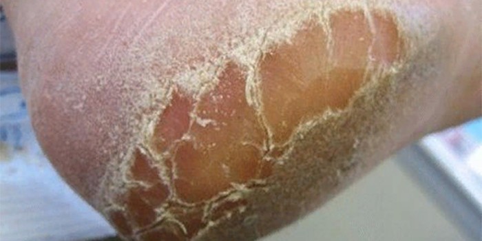 Грибок кожи ног - первые симптомы, причины и виды болезни, как лечить область поражения стопы