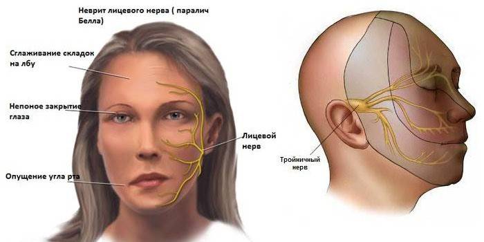Неврит лицевого нерва, схема