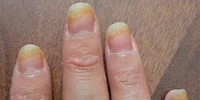 Грибок ногтей пальцев рук