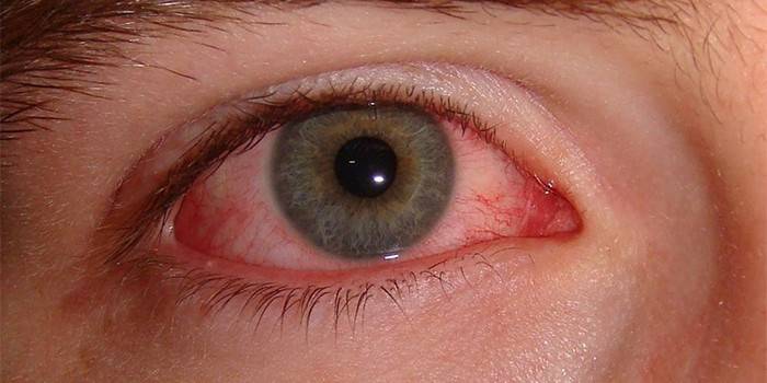 Пораженный грибком глаз человека