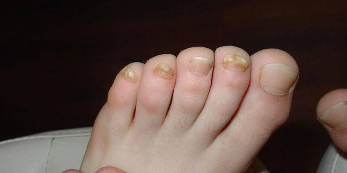 Грибок ногтей на пальцах ноги