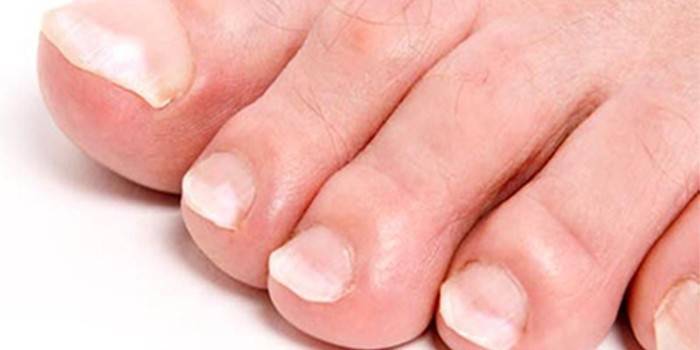 Онихолизис ногтей пальцев ног