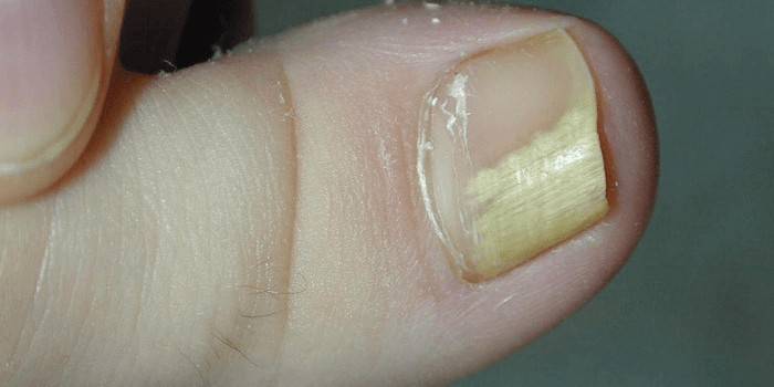 Пораженный грибковой инфекцией большой палец ноги