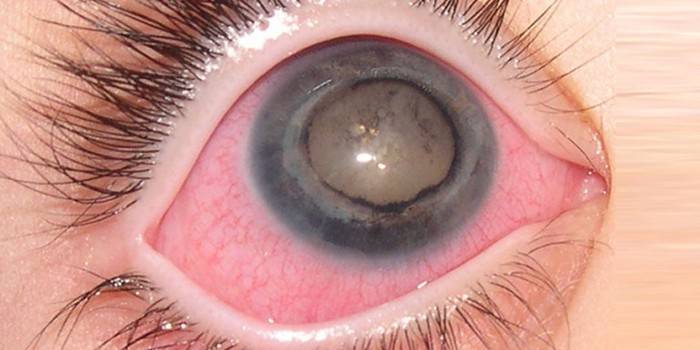 Гемералопия глаз