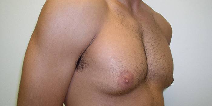 Увеличенные грудные железы у мужчины