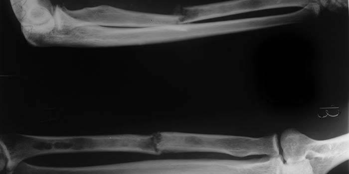 Рентгеновский снимок перелома лучевой кости руки
