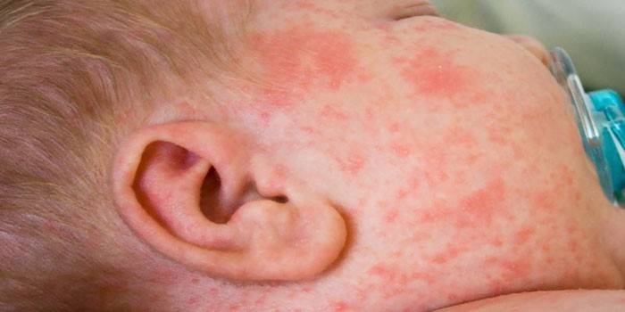 Аллергическая сыпь на лице ребенка