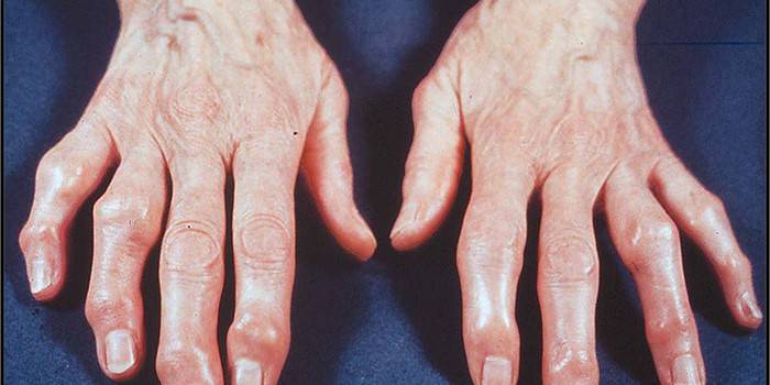 Руки женщины с остеоартрозом суставов пальцев