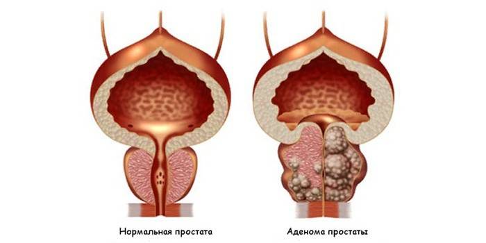 Здоровая простата и аденома простаты