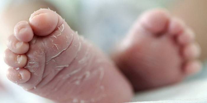Шелушение кожи на ступнях новорожденного