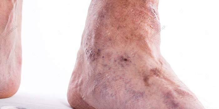 Проявление тромбоза на ноге у мужчины