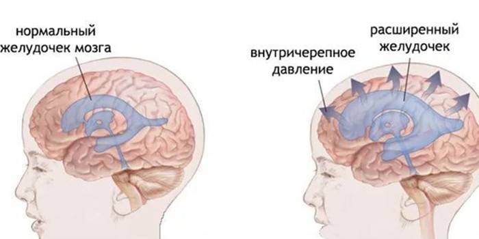 Схема нормального мозга и изменения при внутричерепном давлении