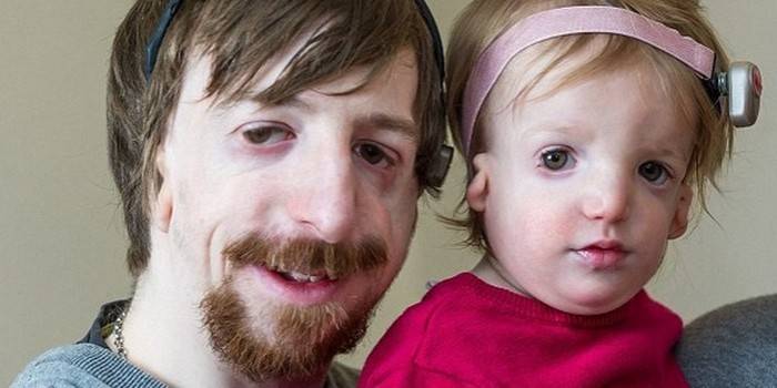 Мужчина и девочка с синдромом Тричера-Коллинза