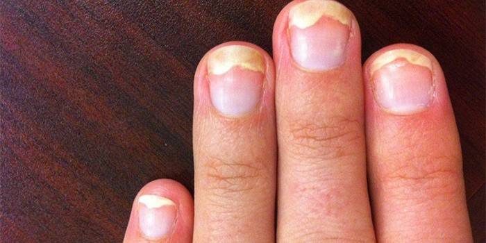 Онихолизис ногтей пальцев рук