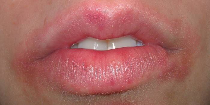 Воспаление кожи вокруг губ