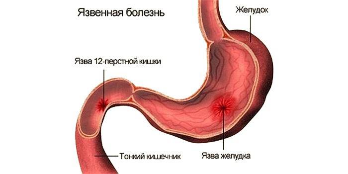 Схема язвенной болезни