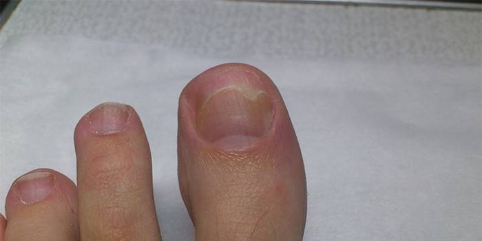 Онихолизис на большом пальце ноги
