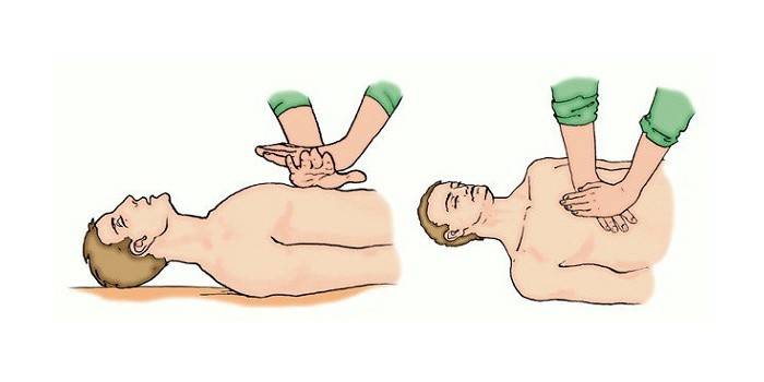 Схема как проводить непрямой массаж сердца