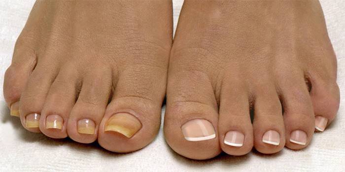 Больные и здоровые ногти на ногах женщины