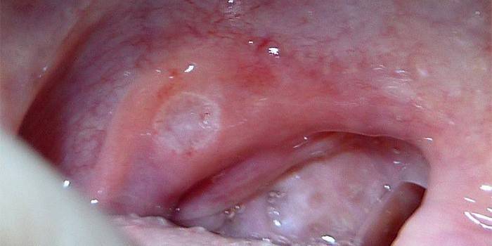 Проявления стоматита в полости рта 