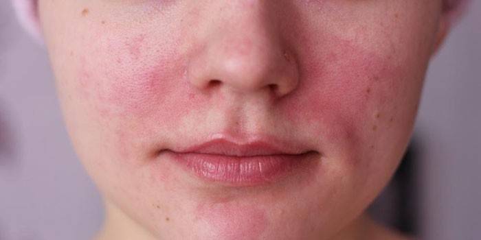 Аллергия на лице девушки 