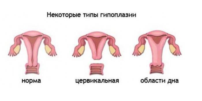 Типы гипоплазии матки