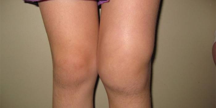 Деформированный коленный сустав