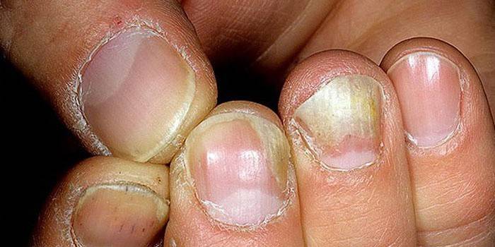 Пораженные грибковой инфекцией ногти рук
