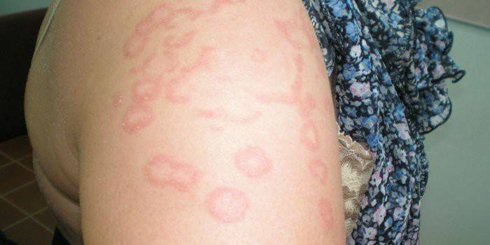 Проявления аллергического васкулита на коже у женщины