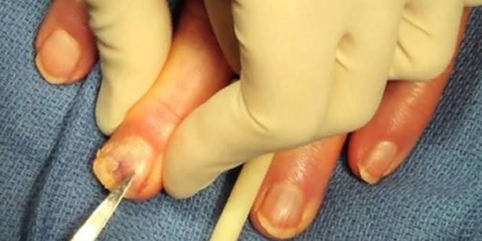 Хирургическое удаление ногтя на руке