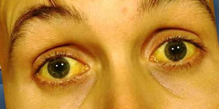 Проявление желтухи на коже лица и склерах глаз