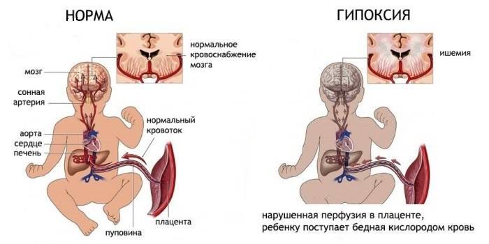 Гипоксия плода при нарушенной перфузии в плаценте